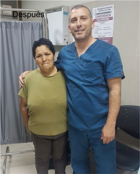 Dr. Antonio Lahoud | Cirujano bariátrico y metabólico. | Testimonios | Rayda Vargas después de la cirugía de manga gástrica | Lima - Perú